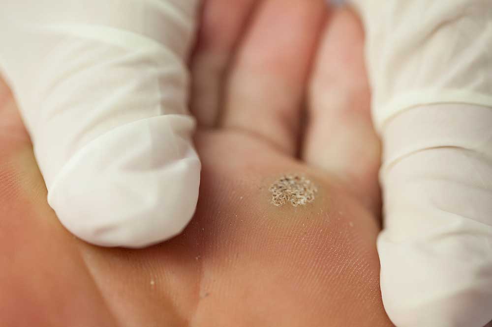 Fodbehandling - Fodvorte behandling