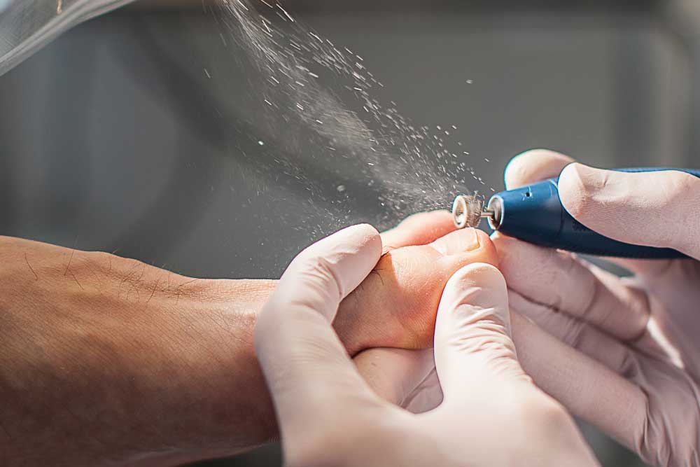 Fodbehandling - Neglebehandling ved fodterapeut