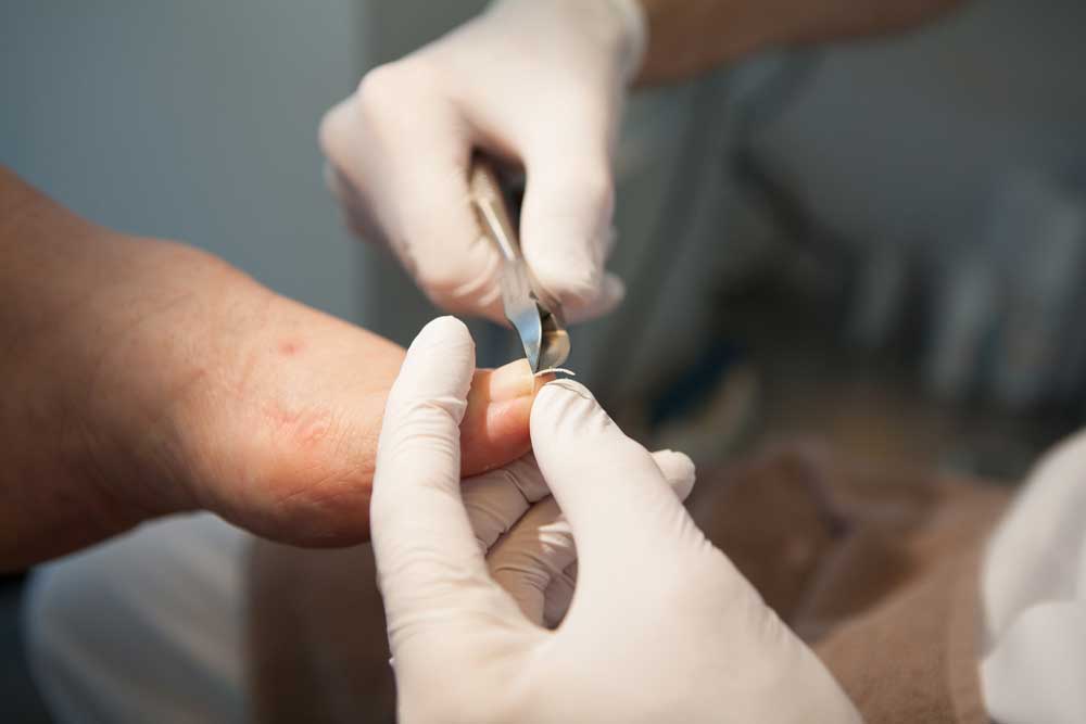 Fodbehandling - Negleklip ved fodterapeut